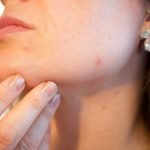 skin-picking-therapie